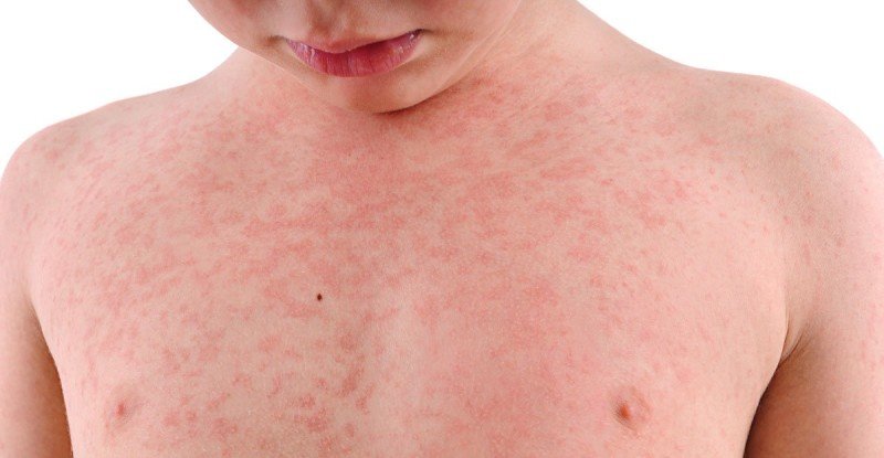 Мазь от аллергии. Как устранить аллергическую сыпь – статья на сайте Аптечество, Нижний Новгород